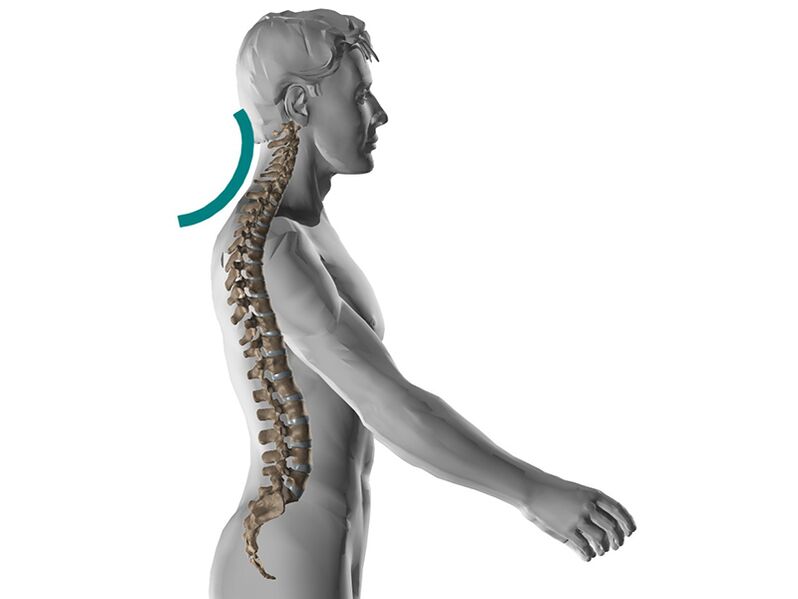 Ostéochondrose cervicale de la colonne vertébrale, qui provoque de nombreux symptômes désagréables