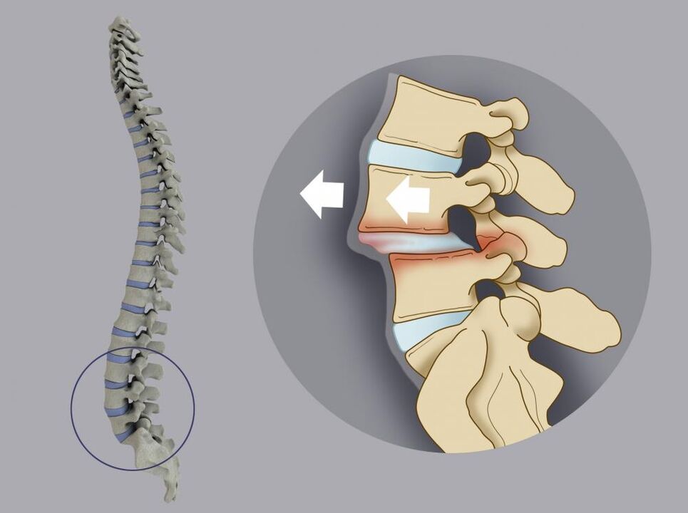 Le mauvais alignement vertébral comme cause des maux de dos