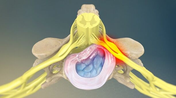 Le syndrome radiculaire comme cause de douleurs lombaires